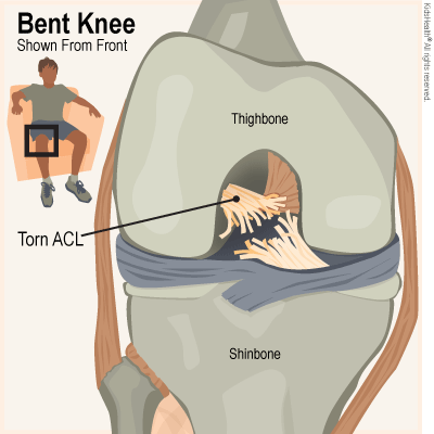 This illustration shows what my ACL would have looked like from September 2nd to November 19th.